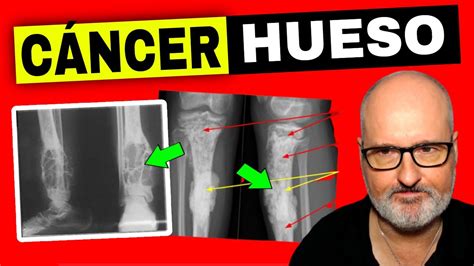 cancer en los huesos-1